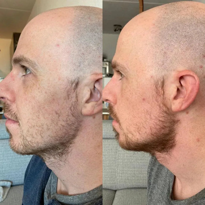 Neofollics beard growth serum (7% Neoxyl) - Hairgivers